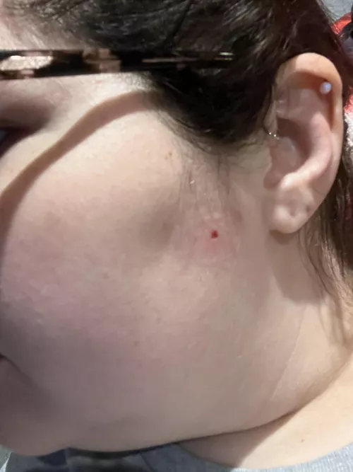 Had an irregular shaped mole shaved off my face today. It’s very red around it because I’m allergic to adhesive. Doctor sent it for biopsy and said they’ll call in the next few days. Fingers crossed it’s benign🤞🏻 by KaylaRocksss