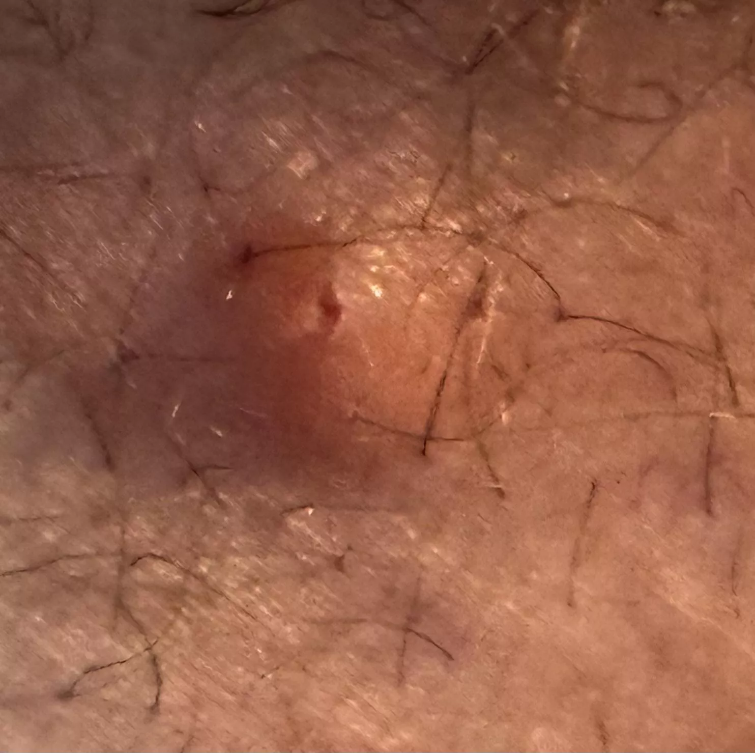 Inner thigh boil that accidentally got popped! What do I do? posted by sweettinkerbell