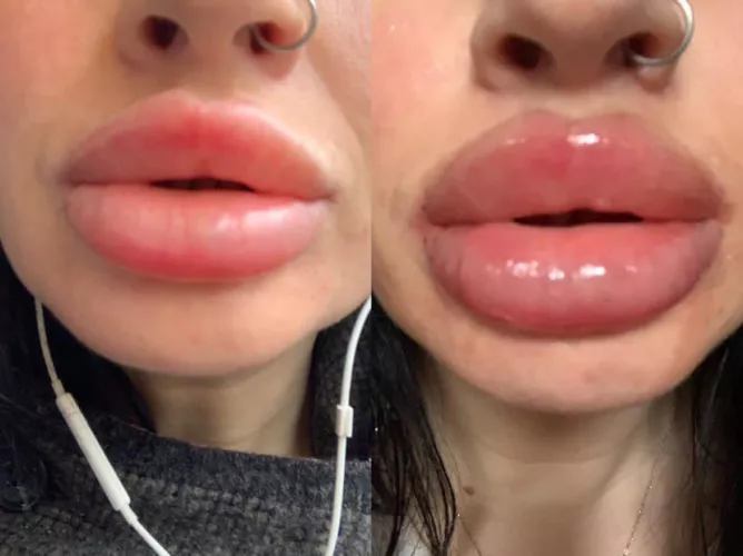 Just had a 2.5ml top up in two weeks I’ll have the same again by jassbusters