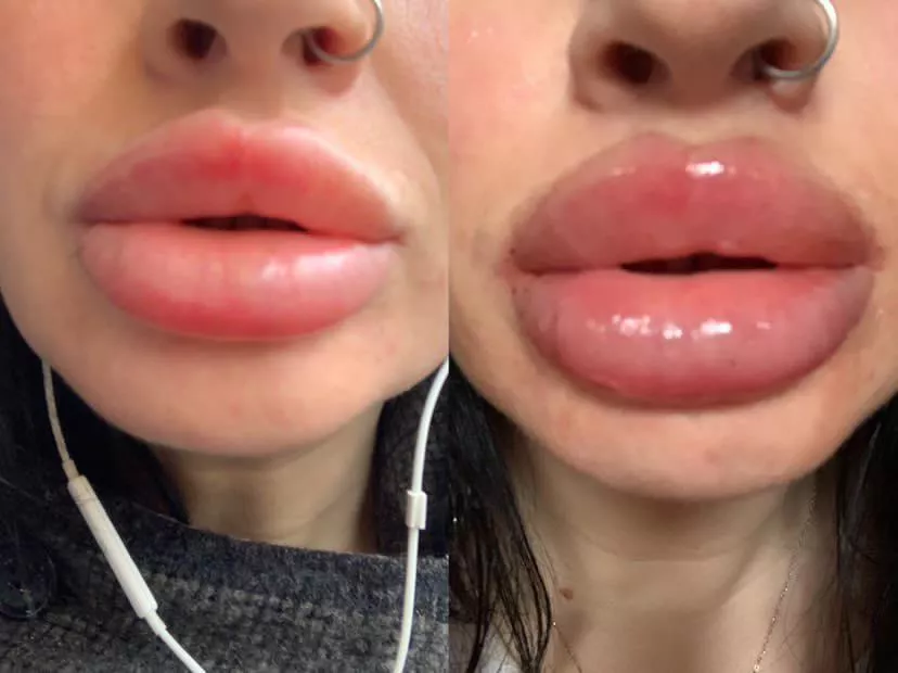 Just had a 2.5ml top up in two weeks I’ll have the same again posted by jassbusters