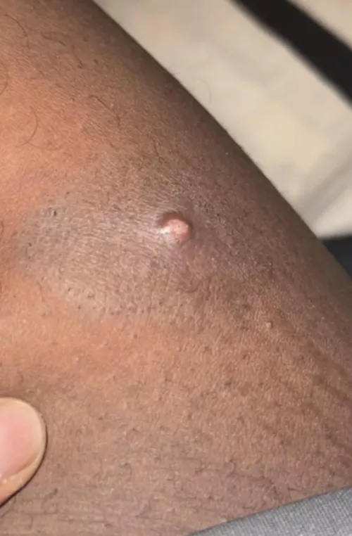 What is this under my thigh, Cyst or Pimple? by Low_Client_2942