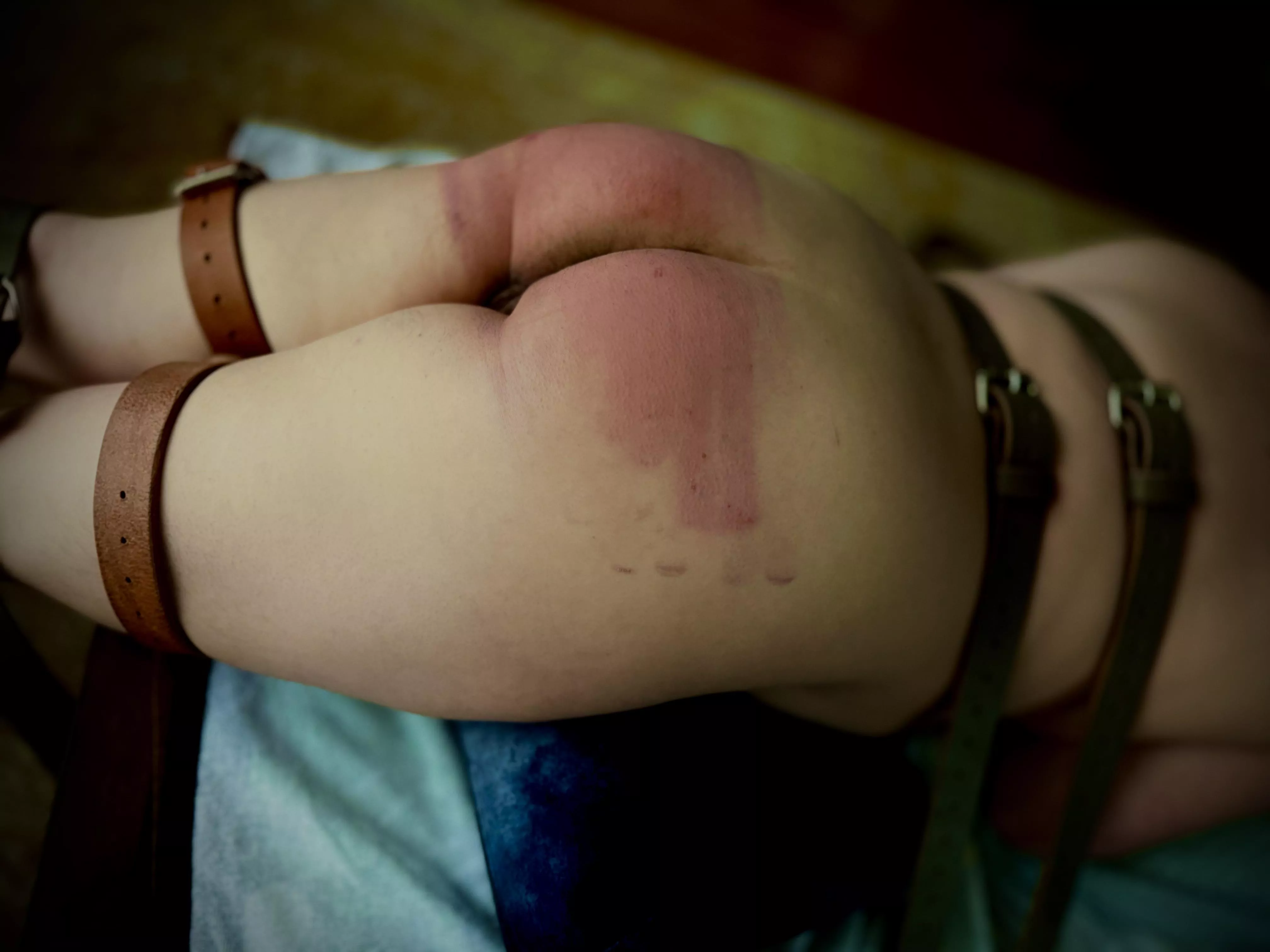 Whoops I did it again - tawsed over bruises [f] posted by allrightth3n