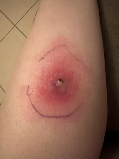 Another update on my cellulitis by krisc2619