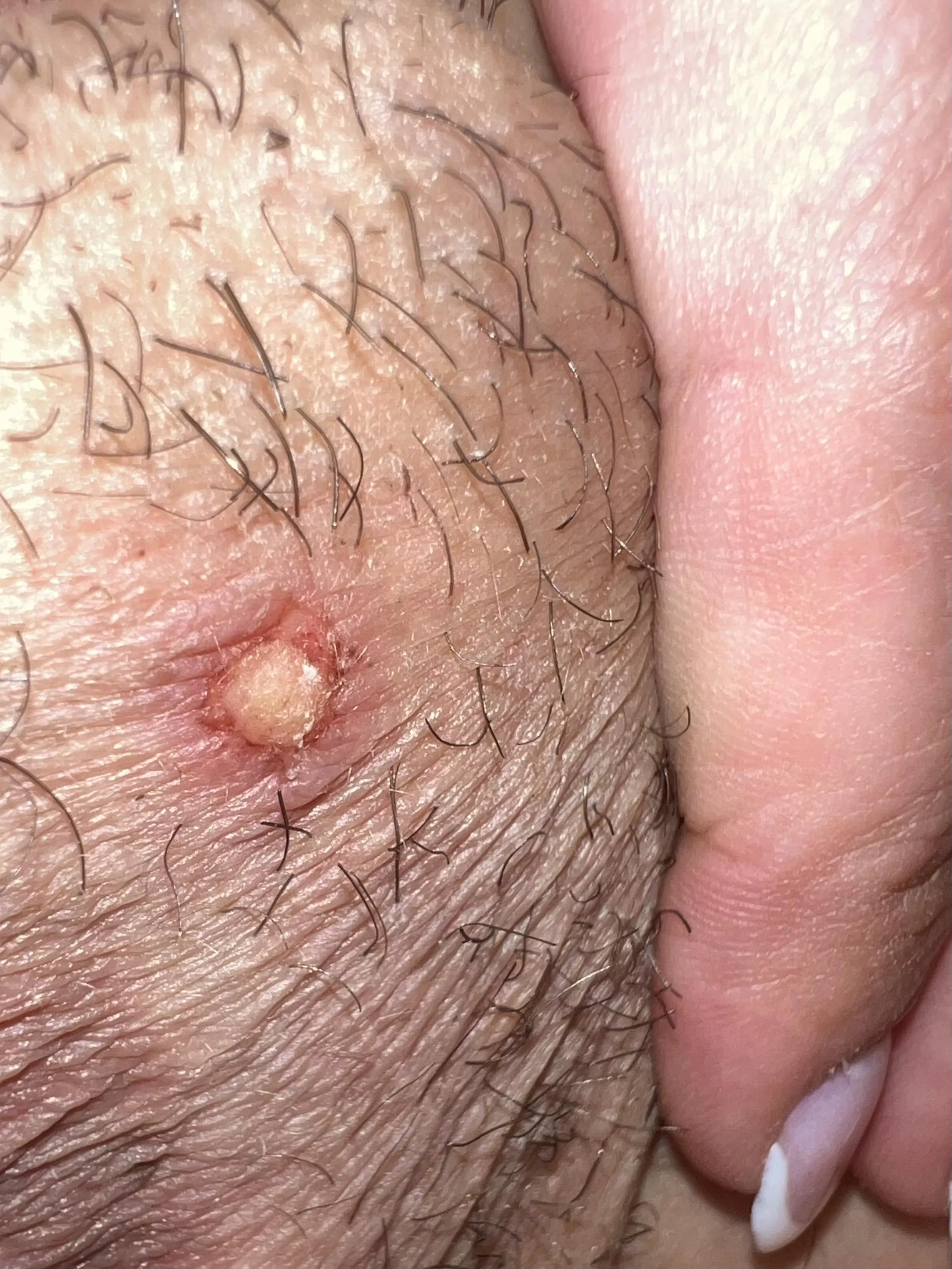 Dug too deep for ingrown hair & scraped layer of skin off posted by Actual_Crab1620