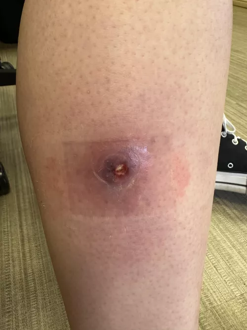 Cellulitis girl update! by krisc2619