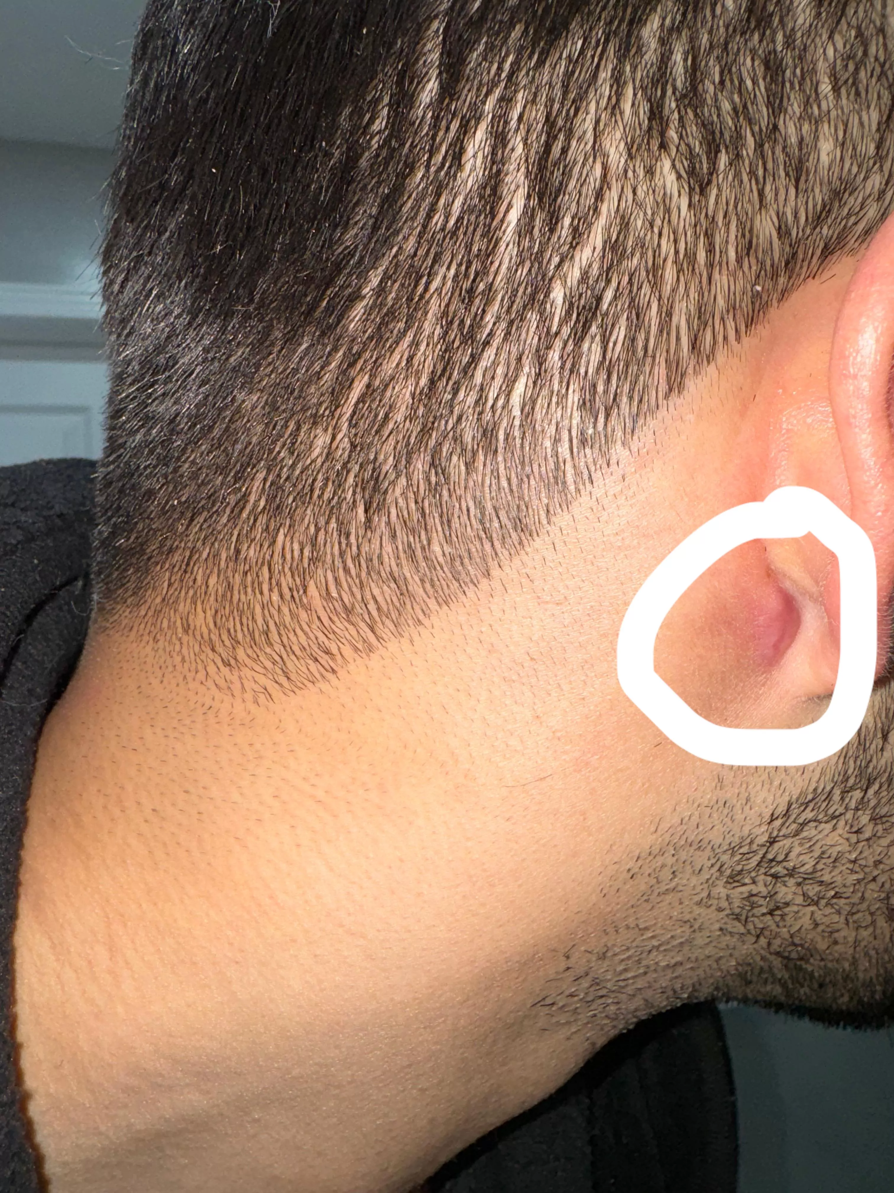 Best way to heal drained cyst? Scab already formed and fell off  posted by BayerischeMotorenAG