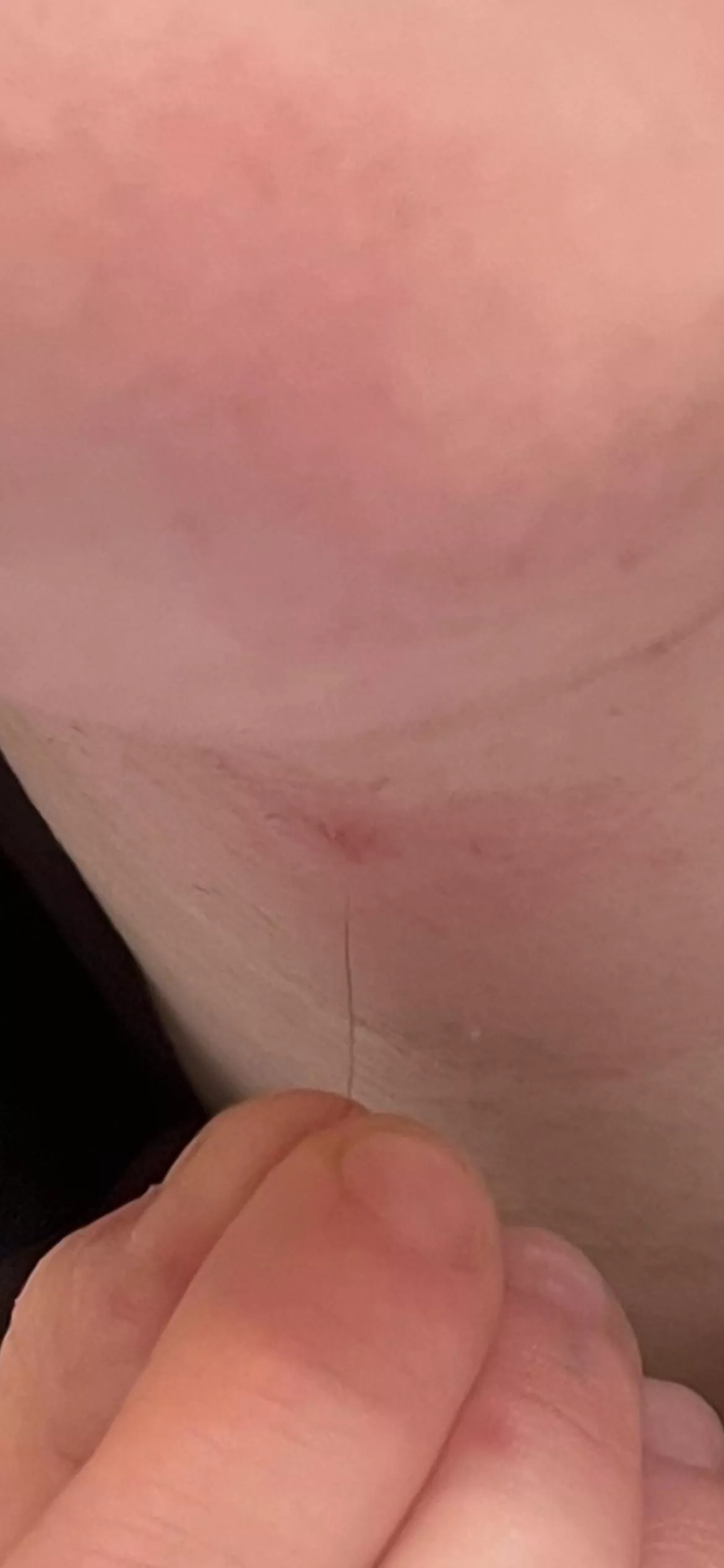 Finally got this ingrown hair out that’s been hiding for a year posted by pearlegs
