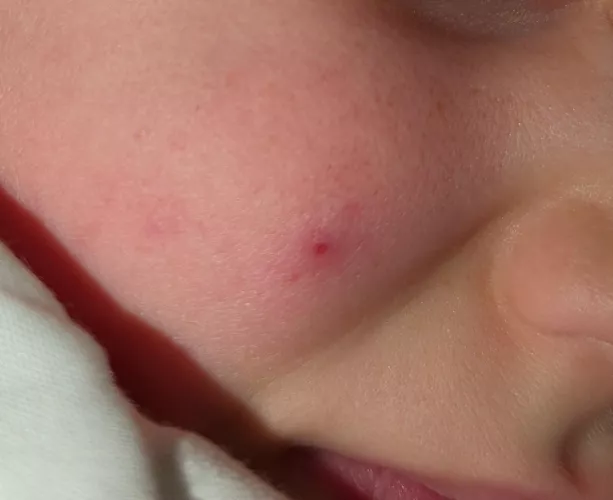 Forbidden Pop: cyst on my kid's face by Background-Emu-9748