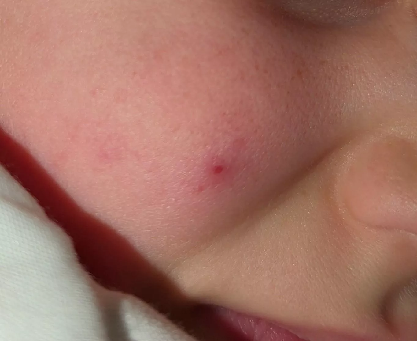 Forbidden Pop: cyst on my kid's face posted by Background-Emu-9748