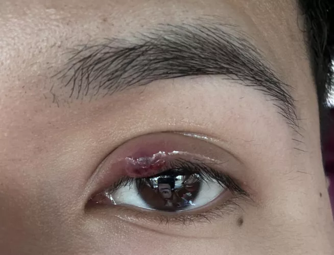 My stye/chalazion popped by PreviousEvening4322