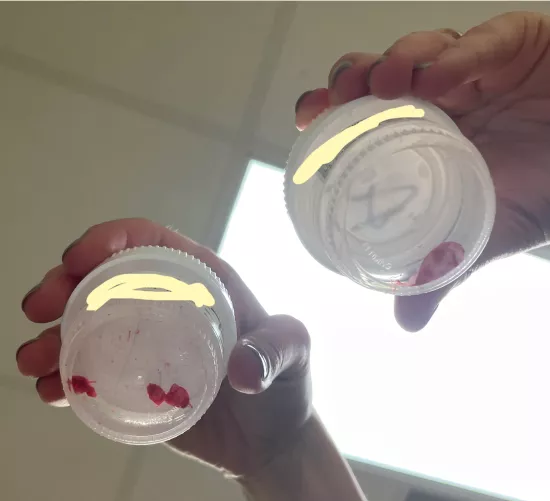 2 Pilar Cysts Removed by FemaleForest