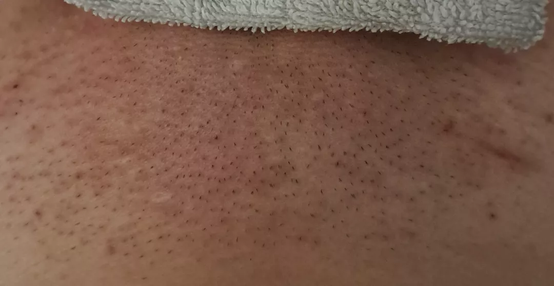 After-shaving Razor Burn forbidden pops ;-; (NSFW just in case) posted by FyreCatz135