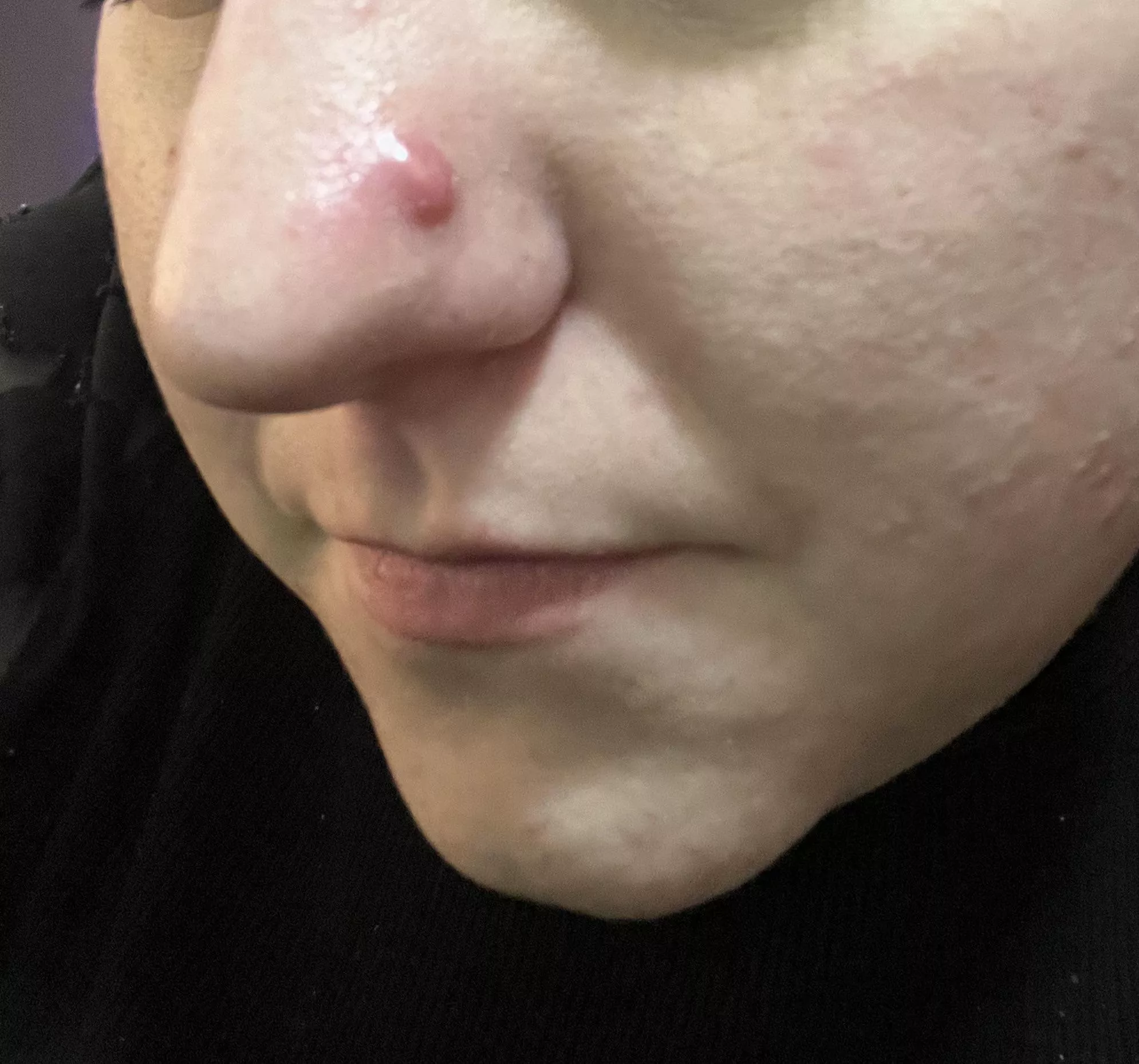 Evil Cyst on my nose posted by Purple_Giraffe3101
