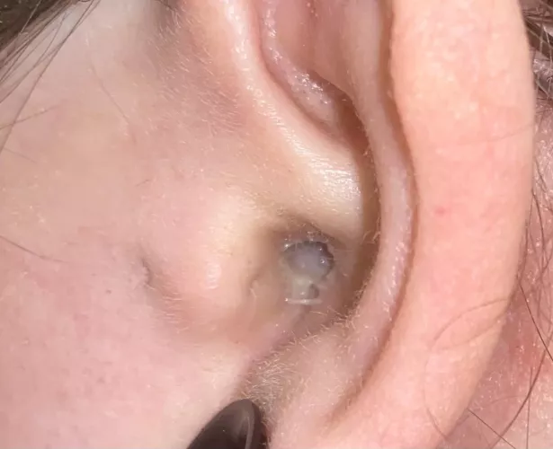 Super painful ear infection with pus !  by 333flowerchild