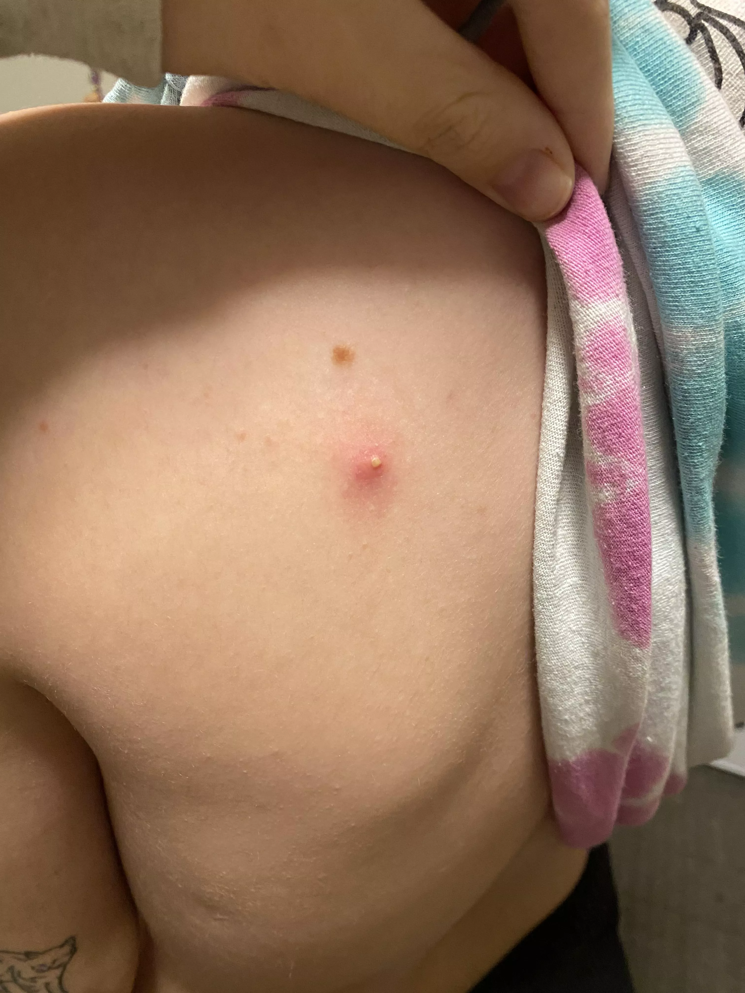 wanted to share my back pimple posted by Prestigious-Goose-30