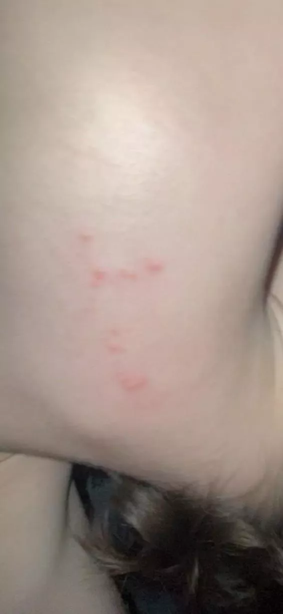 what kind of rash is this? i have them all over posted by Opposite-Acadia-2756