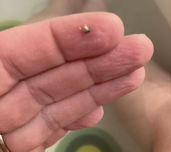 Foreign object (?) from my leg by puppybuttz