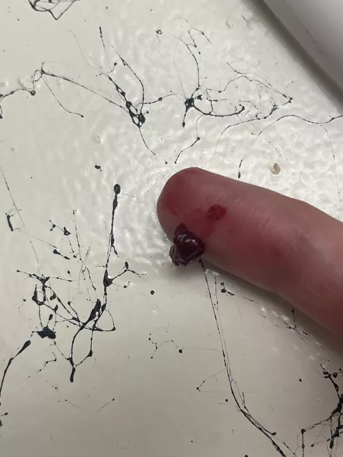 Super painful temple abscess by zmxbv