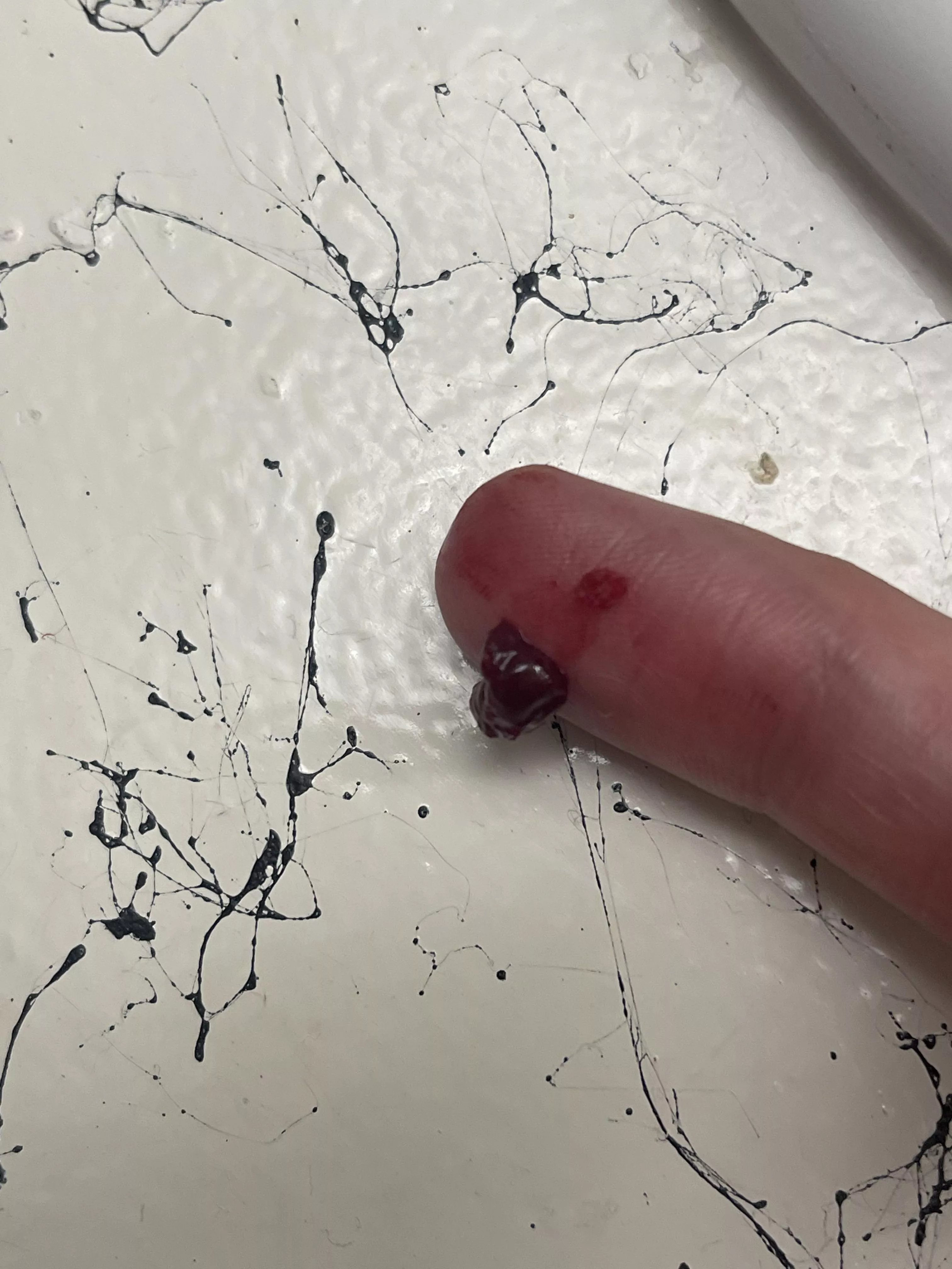 Super painful temple abscess posted by zmxbv