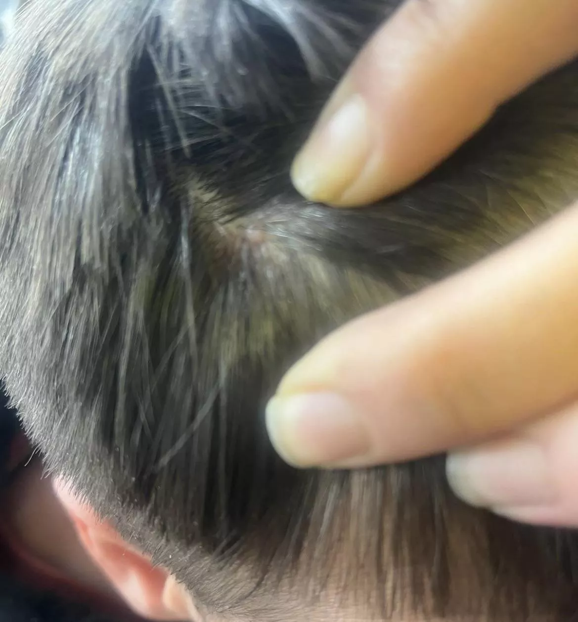 Is this a mole or cyst?? posted by Superb_Appearance559