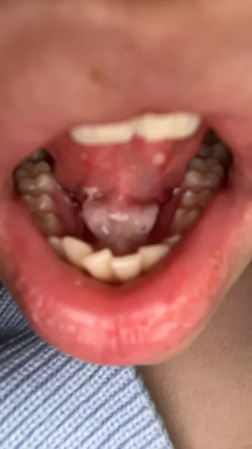 look who came back😃 why are my salivary stones always massive by Winter_Jellyfish1999