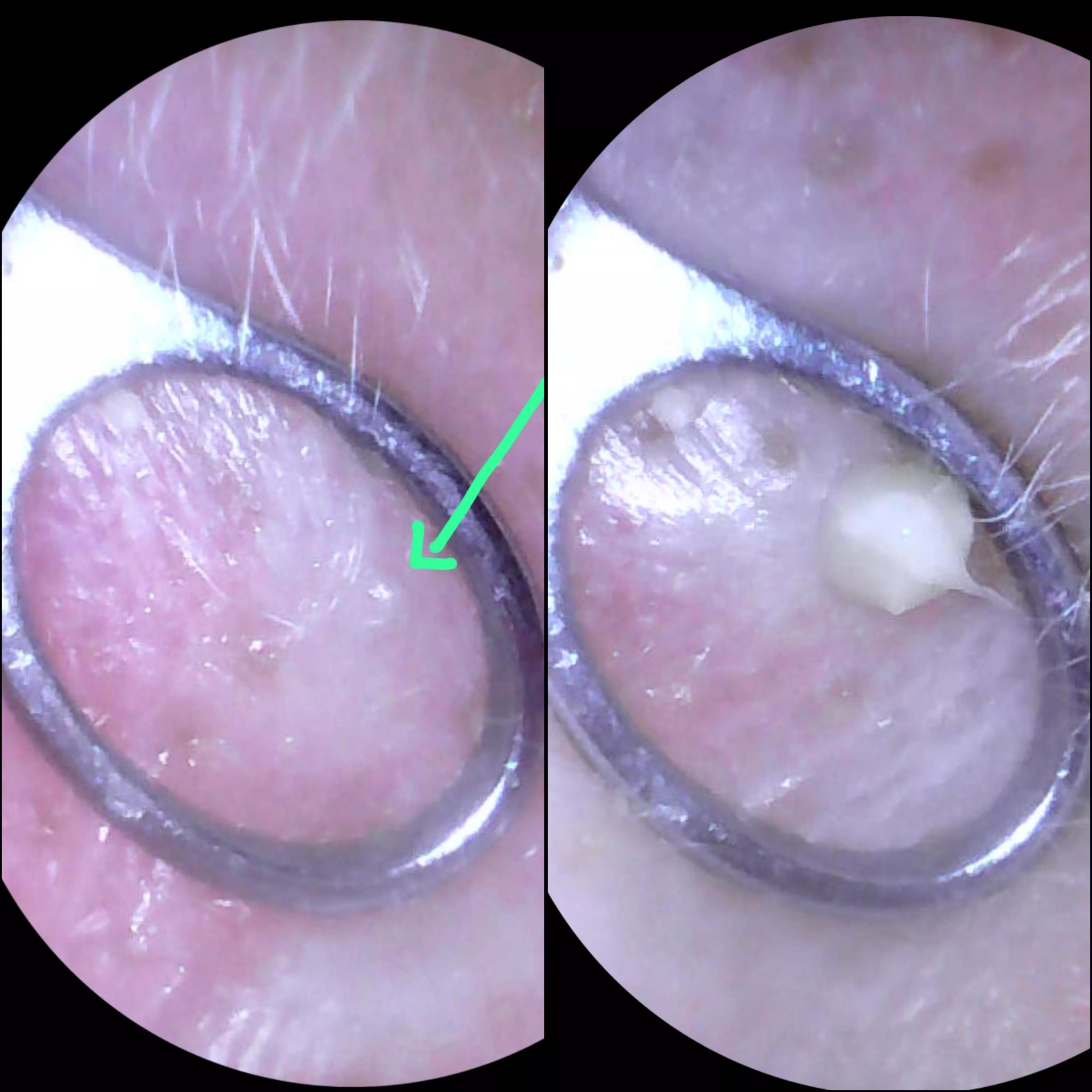 Accidently pressed capture rather than record. Which sucks. But very painful ear, was only a tiny bump but went pop! posted by polystyrenedaffodil