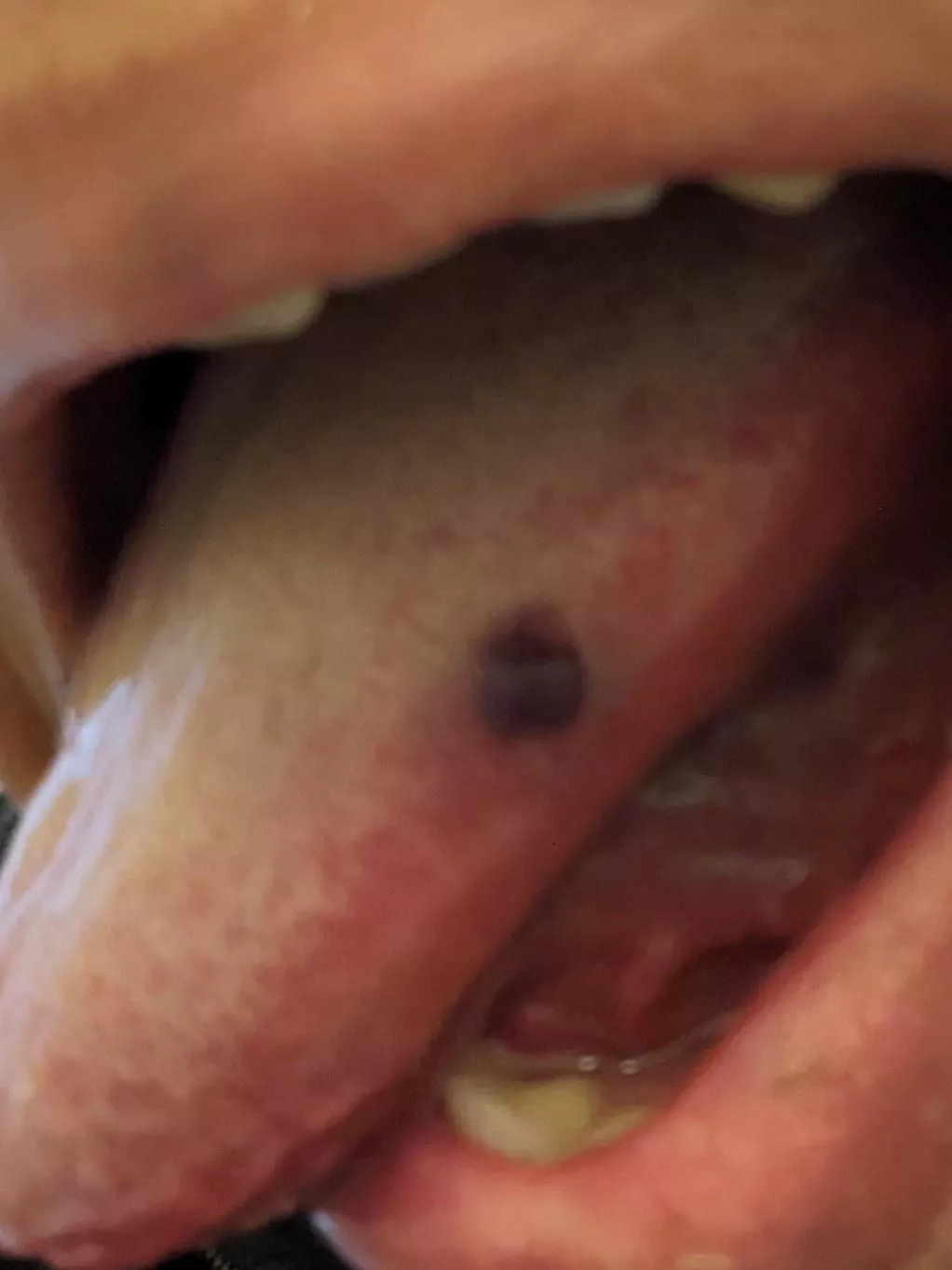 I know when spring is in the air since these little blisters with blood or clear fluid start happening in my cheeks. If I use my fingers to try to pop, they often expand instead of popping. This is the first time in the 20 or so years I've been getting  posted by wing03