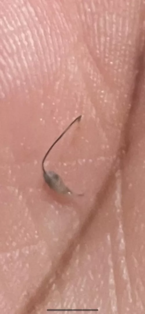 Ingrown/cyst?? Idk.. by SuddenDesigner2804