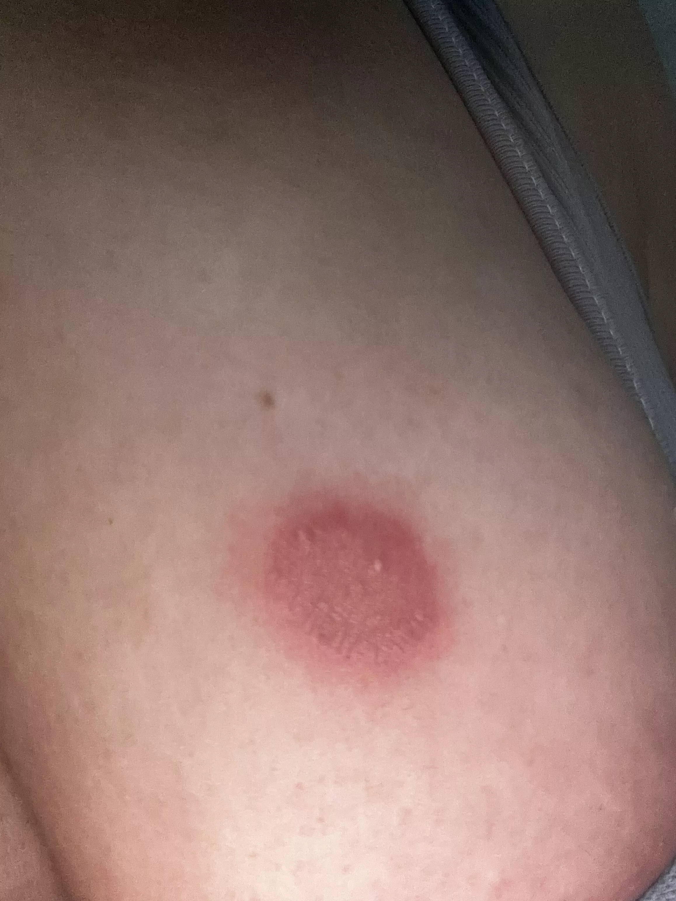 Pustules/ringworm. Forbidden pop! posted by Dmmousa1