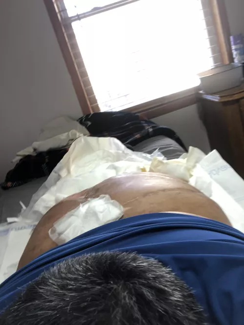 Gay superchub bottom. I am in a wheelchair and paralyzed from the waist down if still interested hmu. Sorry about the bandage in the pic. by Training-Dog7661