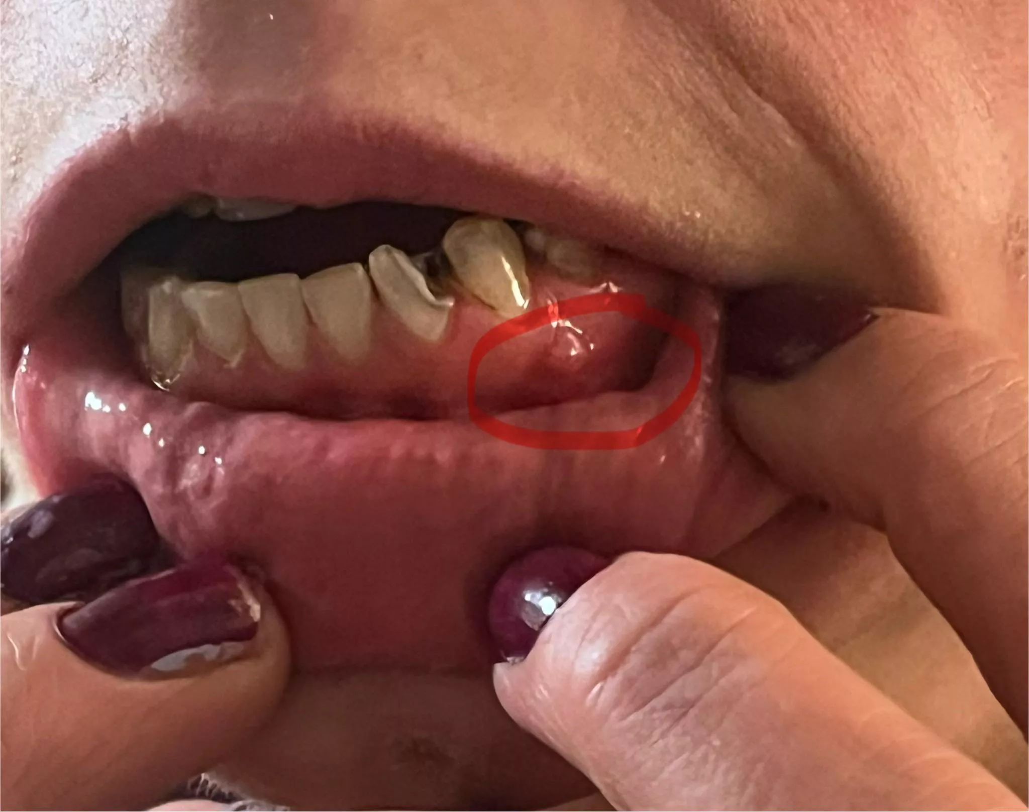 Small abscess - how serious? posted by ShoopShoopAYDoop