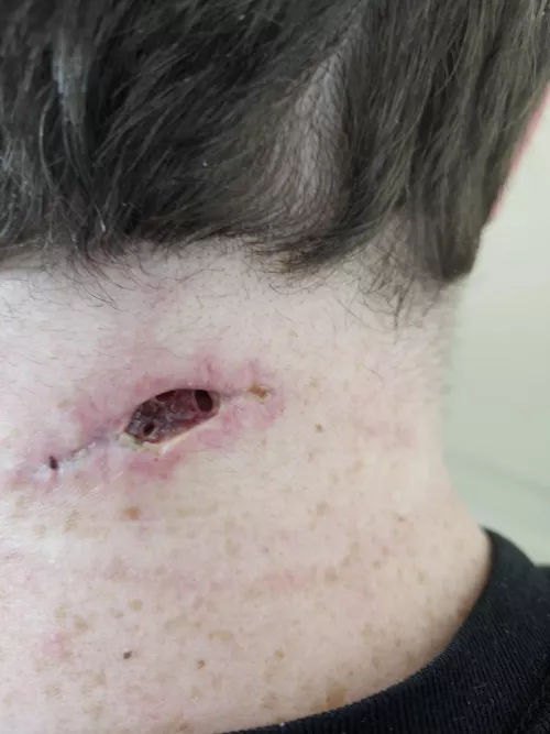 Had a growth removed from my neck almost 6 years to the day an identical growth was removed... by joebaes1