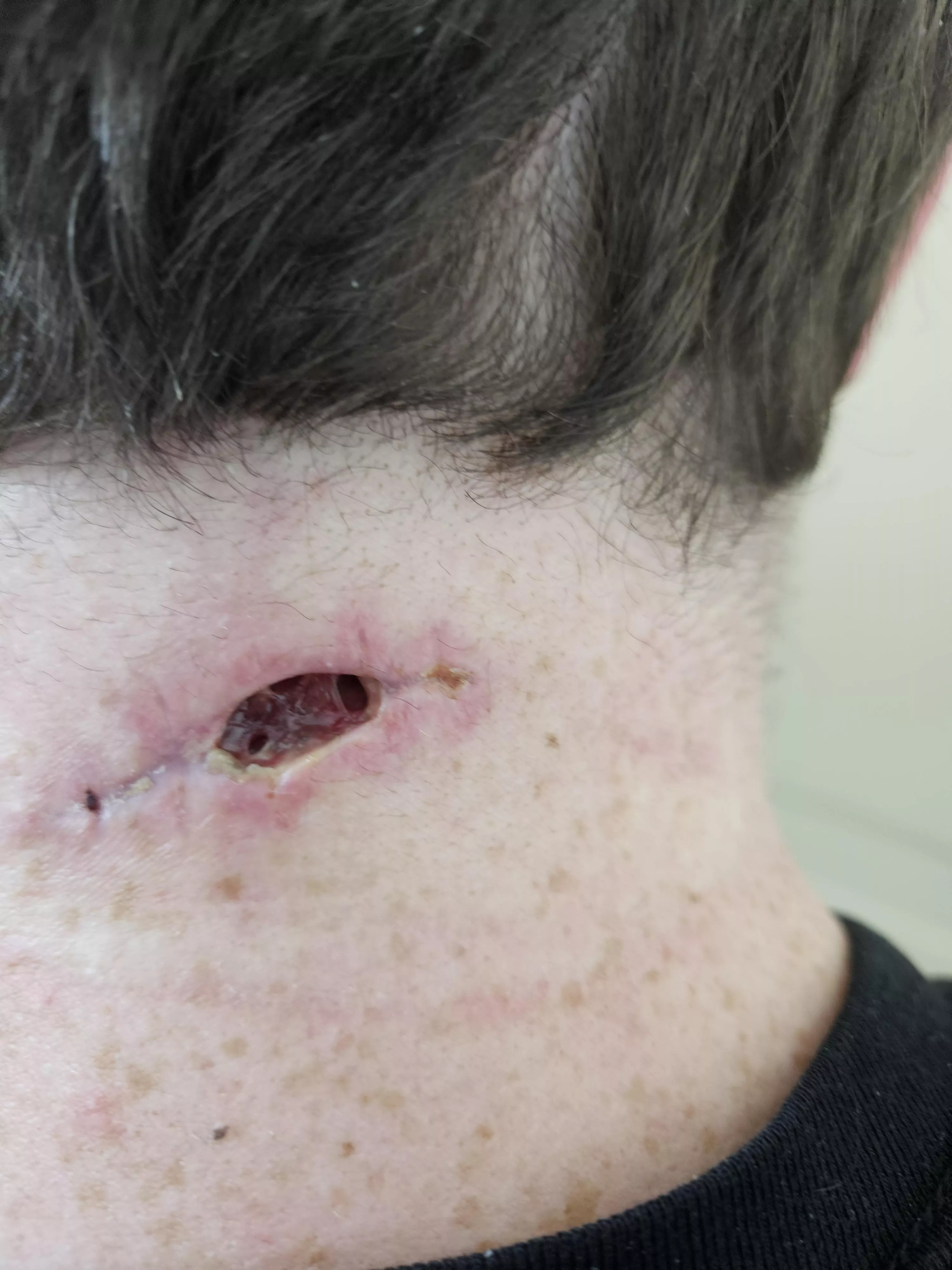 Had a growth removed from my neck almost 6 years to the day an identical growth was removed... posted by joebaes1