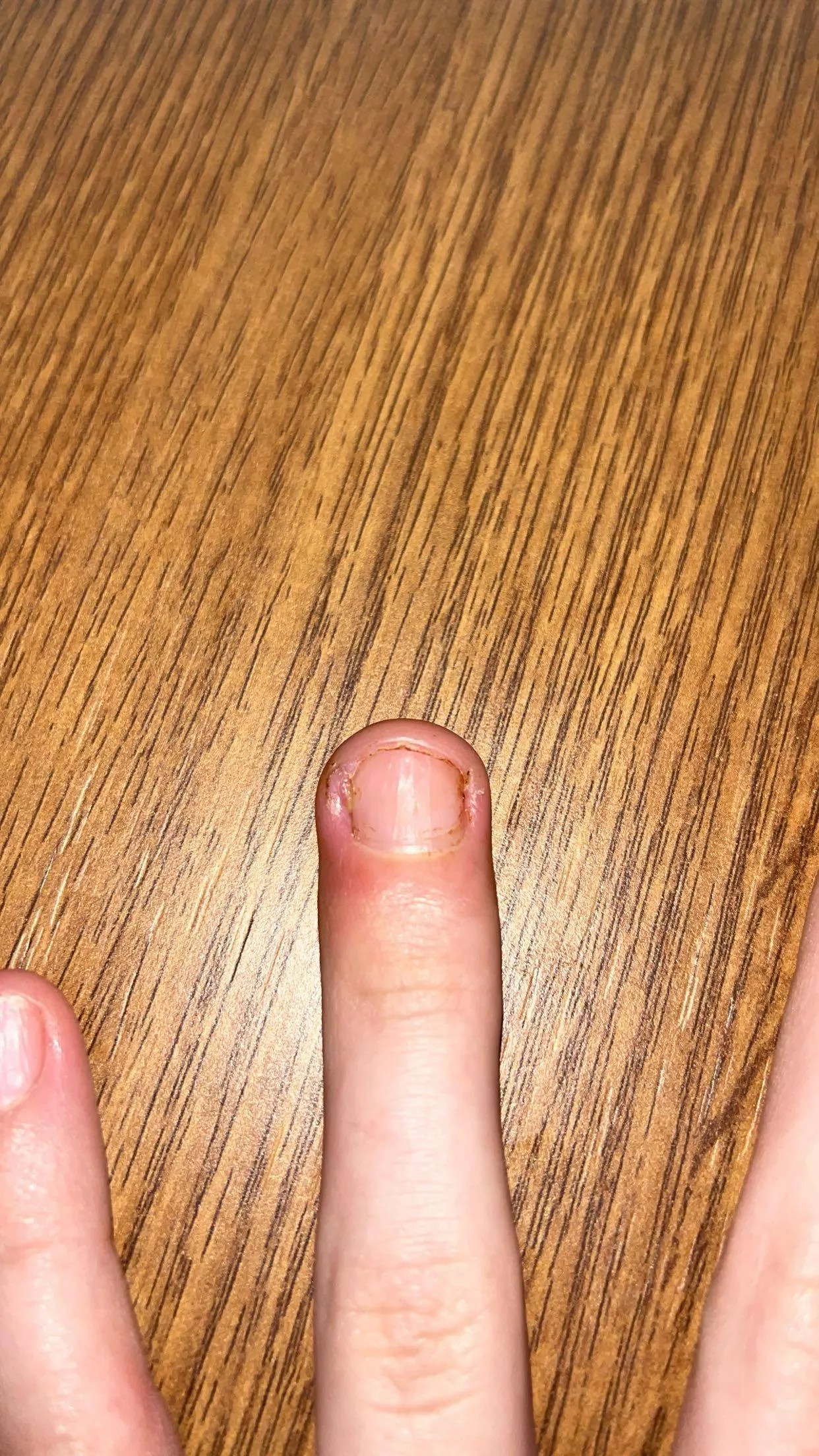 ingrown fingernail hurts so bad. posted by lzukii