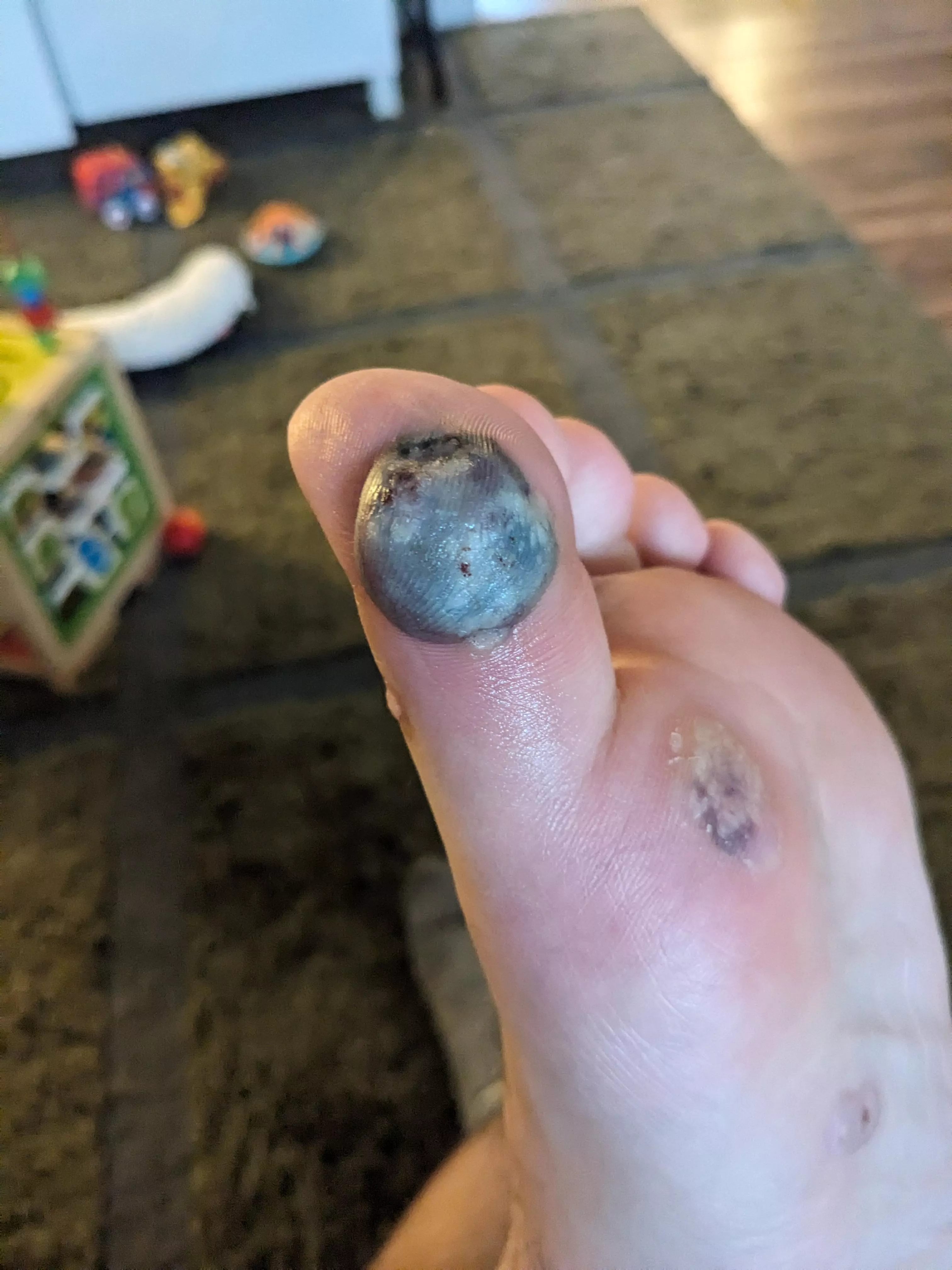 Wart freezing blood blister popping time. posted by PrismTank32