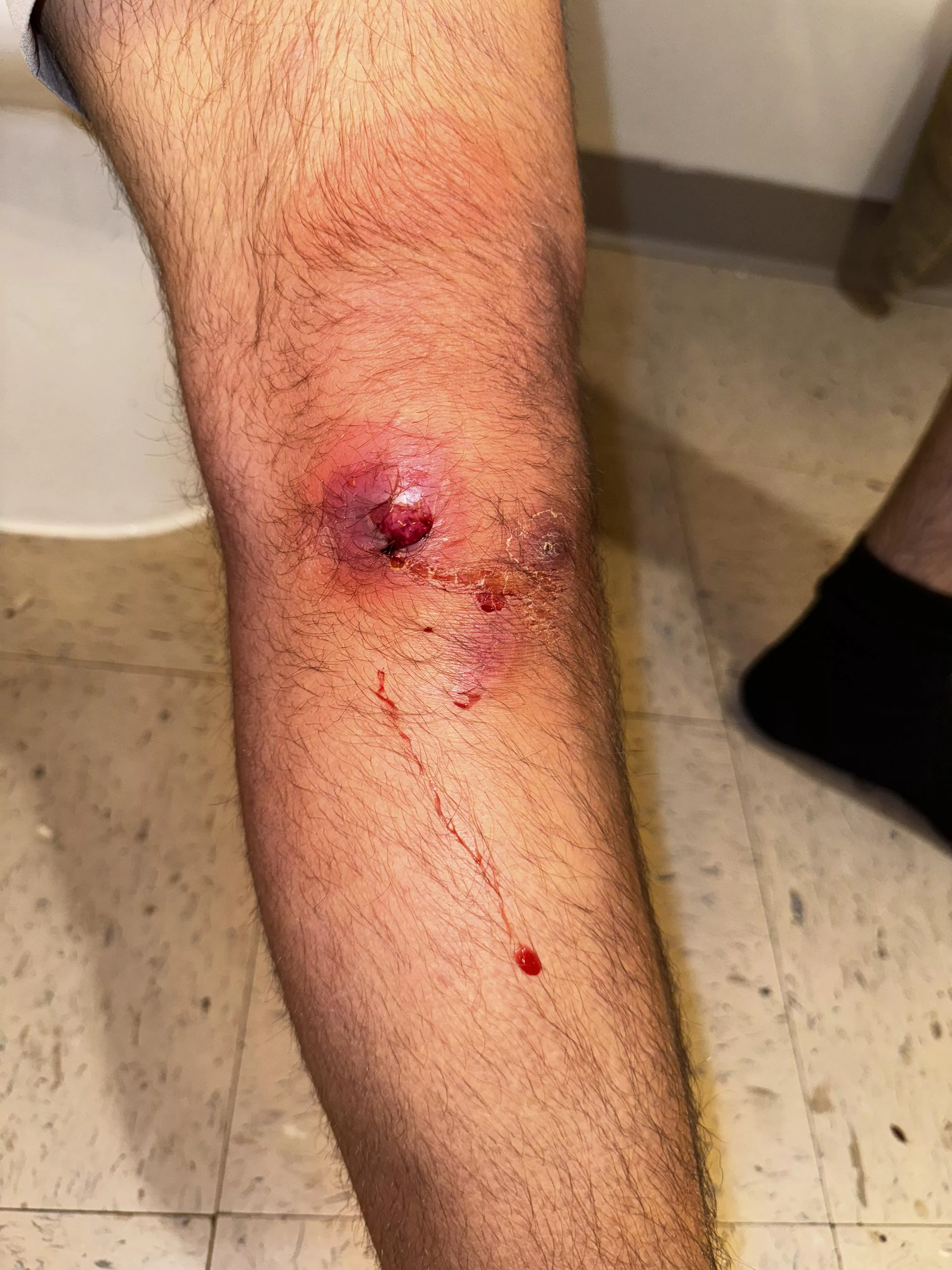 Low grade fevers and painful swelling posted by Brocibo