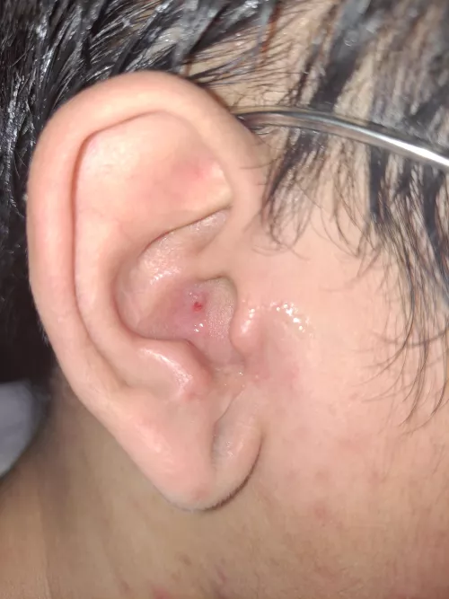 I accidentally scratched my pimple in my ear by Ok-Abrocoma6383