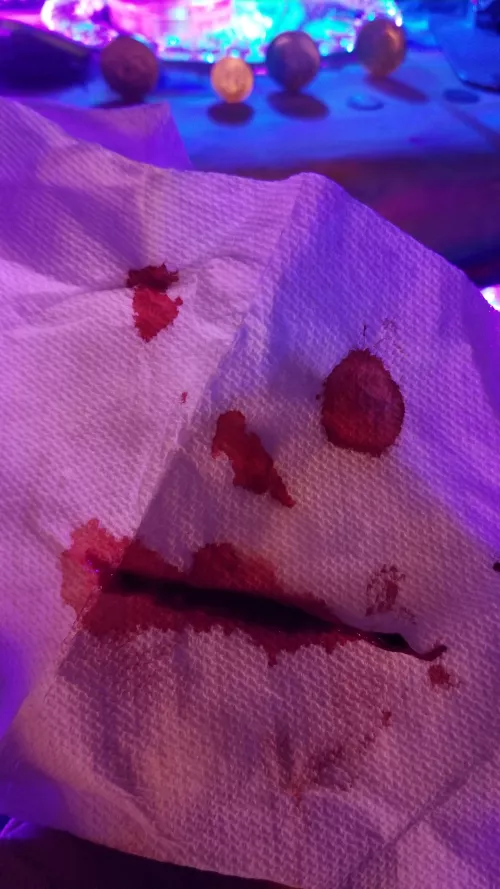 Just had a nose bleed and I unexpectedly made a very scary bloody clown face on my tissue by bakeland