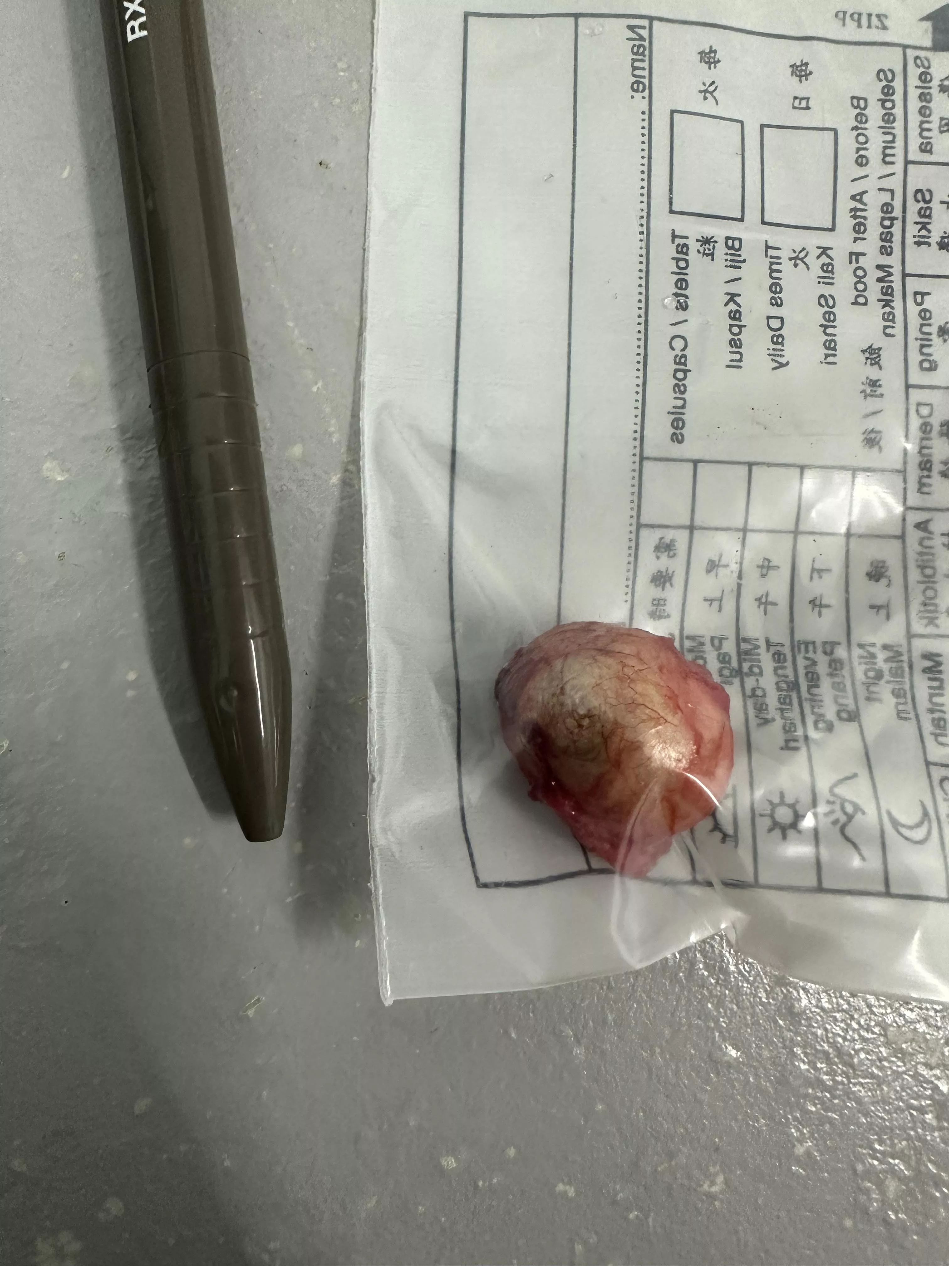 Sebaceous Cyst (Pen for scale) posted by yungmiaw