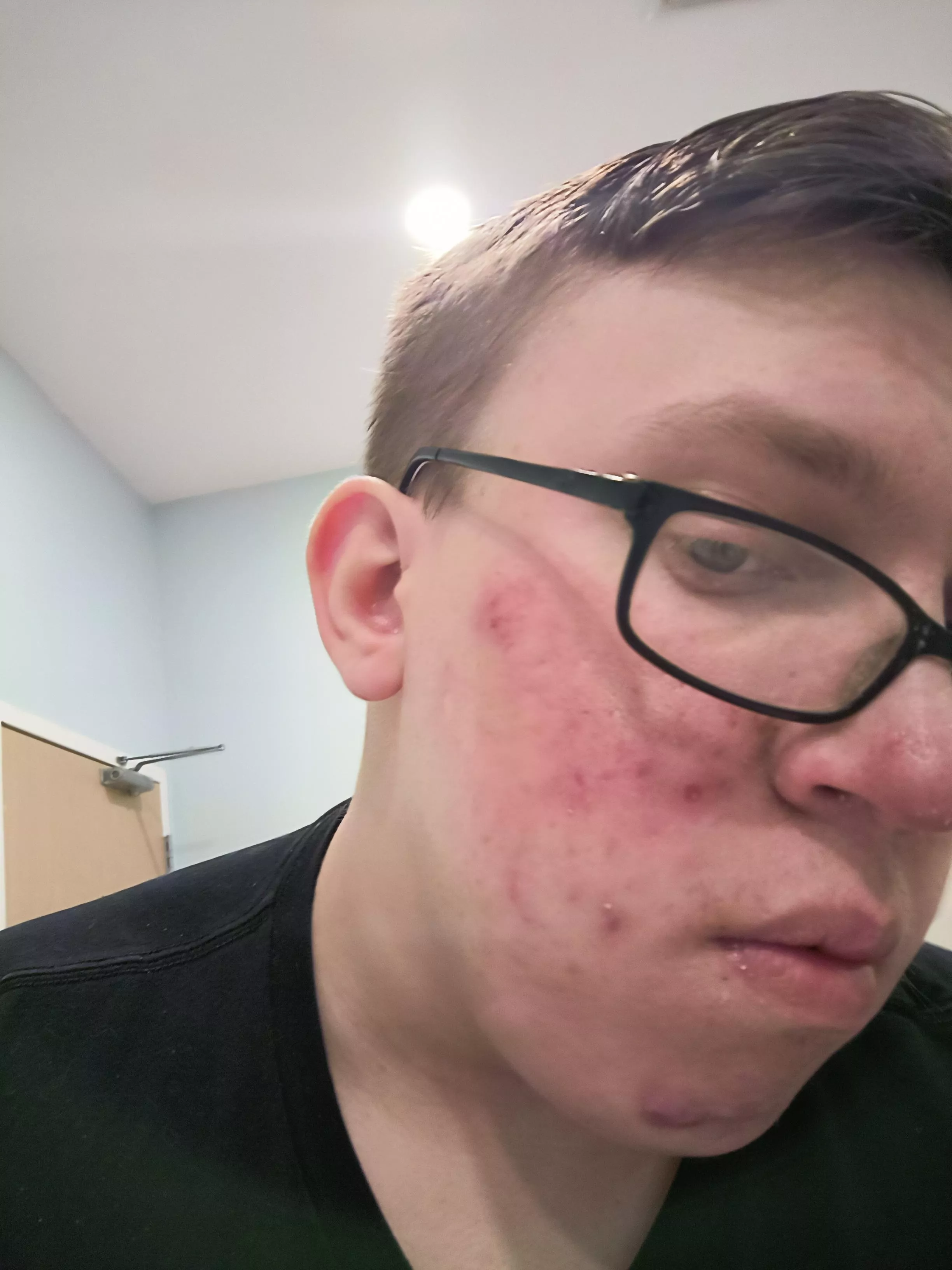 One month progress. Still using cervae, face washing twice a day and doxycycline. Will be having follow-up appointment to address redness.  posted by Moist-Mix-1161