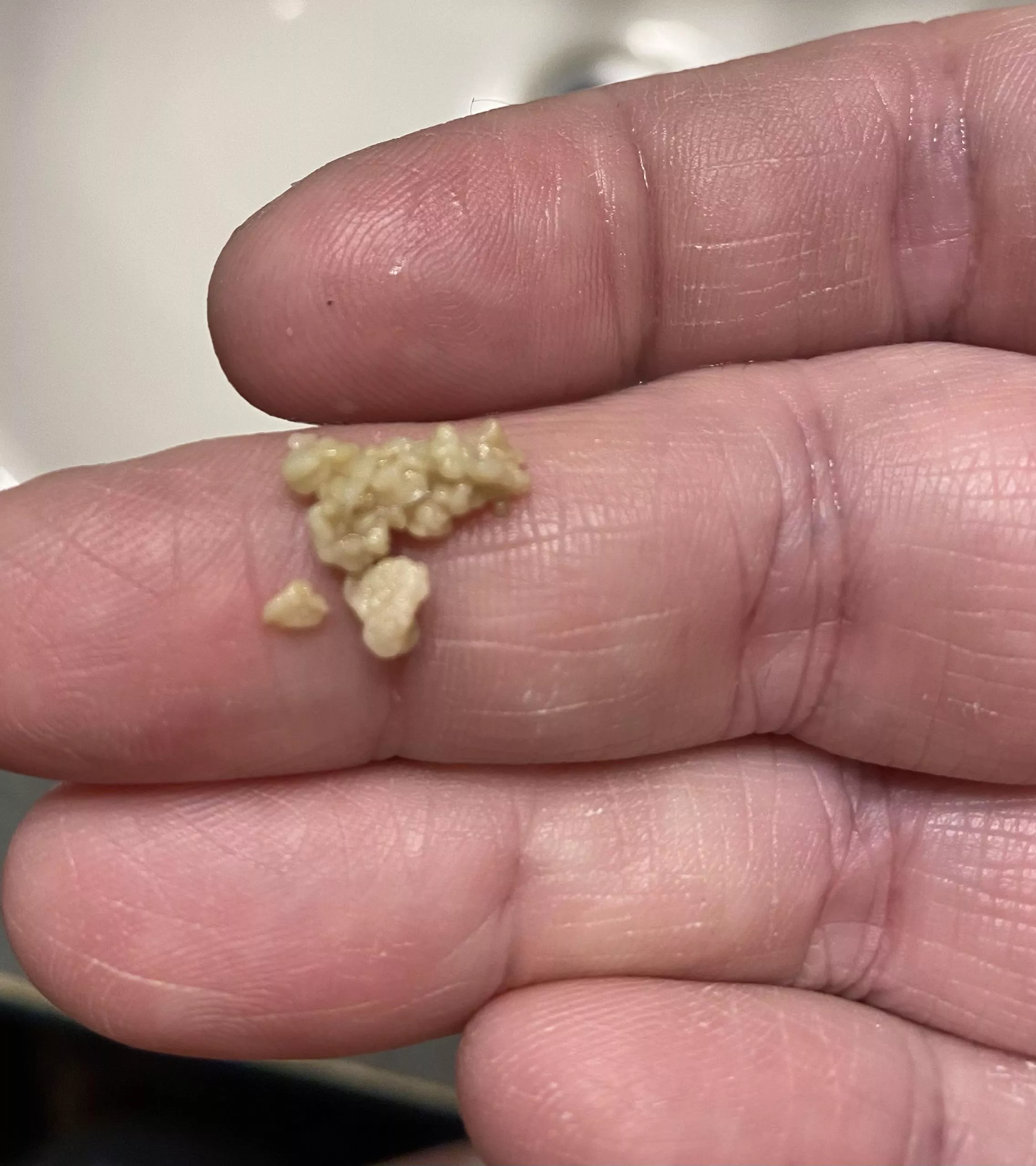 Tonsil Stones that I have to remove every month- only started having these after having Covid posted by rissilly