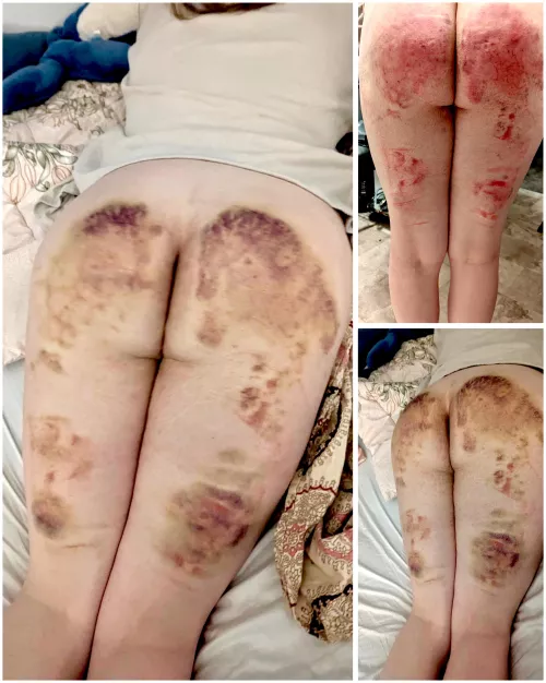 Impact bruises :) by HugznD