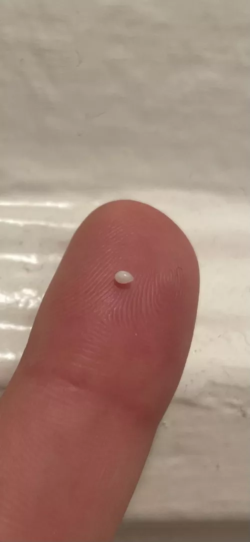 Little pearl emerged from a spot on my leg where I had a small cyst years ago by roguerhetor