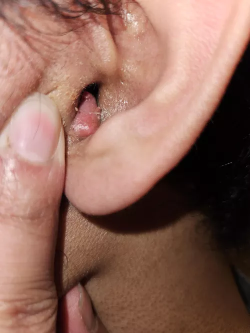 Pimple inside my ear canal by Orangexboom
