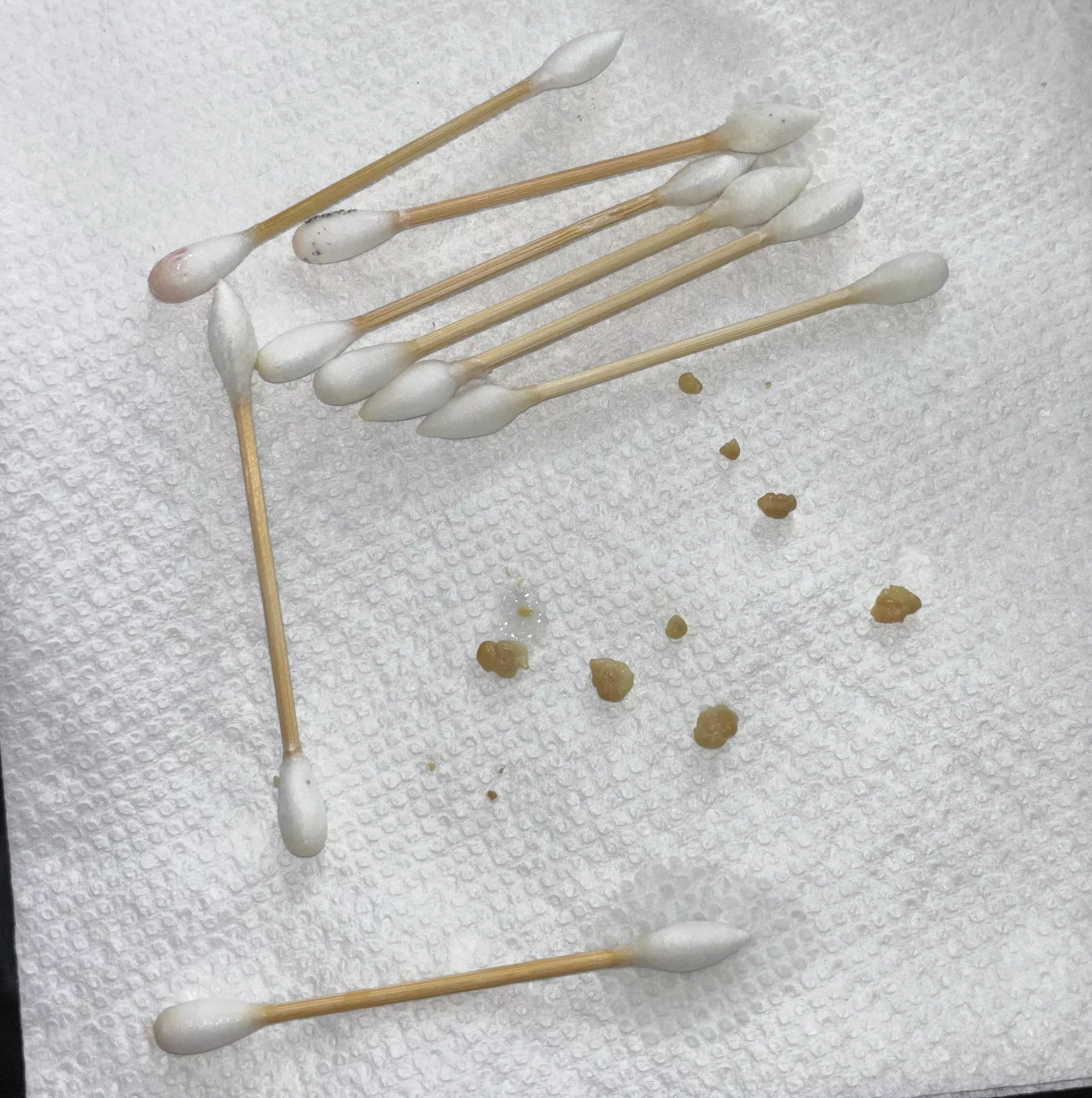 big tonsil stone haul  posted by clarissacoil