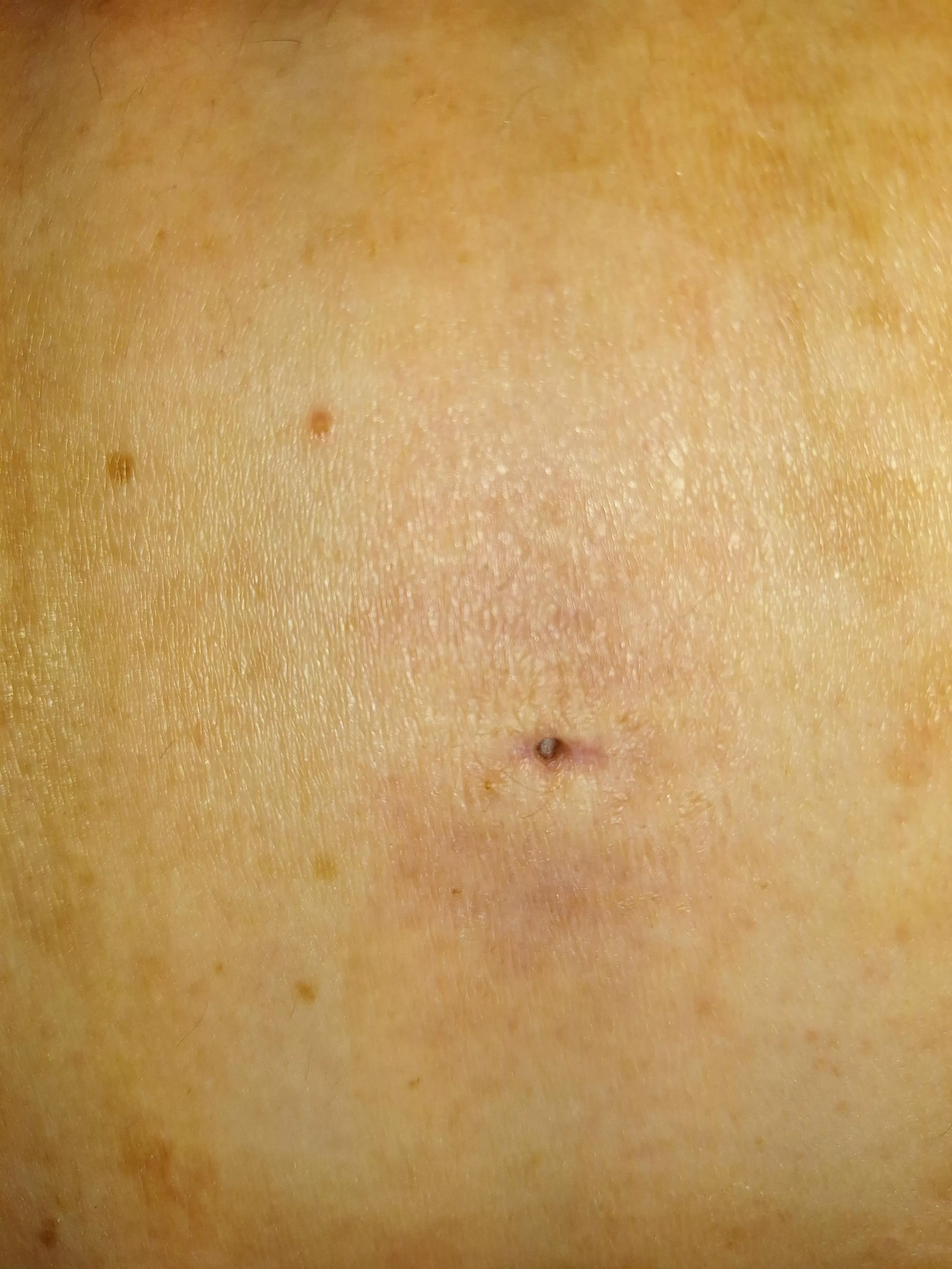 Drained sebaceous cyst hole posted by Numerous_Pitch_9643