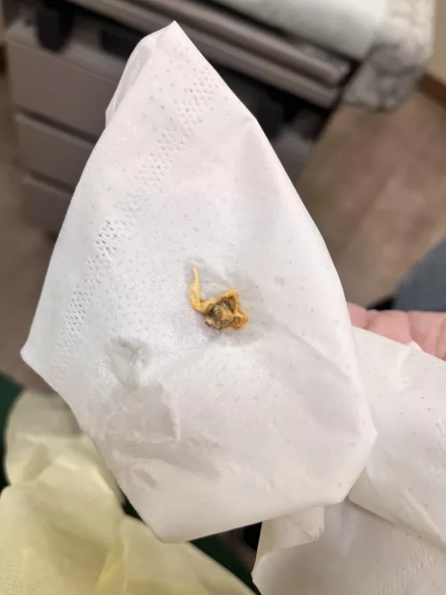 went to dr for ear infection - couldn’t see ear drum because it was blocked by this beast by No_Coat_5794