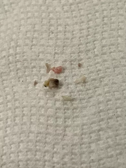 The grody results of what I thought was a regular pimple on my inner thigh from chafing! Wish I'd thought to record the very bloody cyst pop 🍾 by bountyhuntergirl