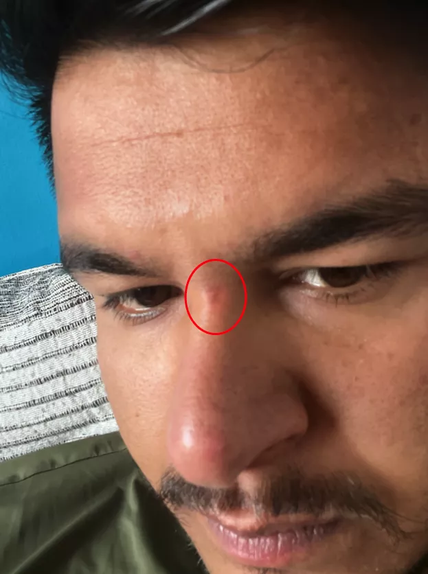 I scratched my face, and a thin layer of skin was removed. Afterward, a scab formed, which I peeled off. Since then, the skin has darkened, and it now looks black, although it appears pink in the picture. Please help me correct the appearance of my skin posted by GeekyPareek