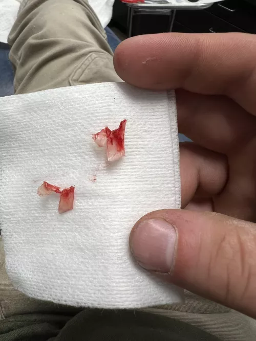 Ingrowns I had removed today by JD3220